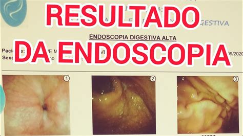 RESULTADO DE ENDOSCOPIA ALTA DIGESTIVA YouTube