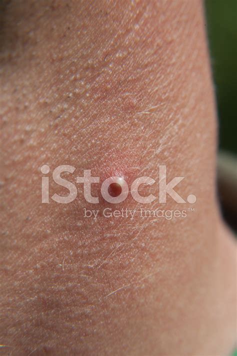 Giant Zit On Neck