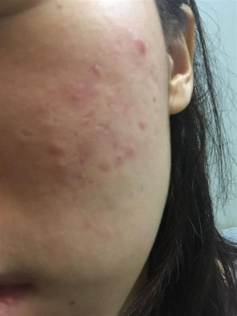 Please Help Severe Acne Scars And Textual Problem Of A 22 Year Old