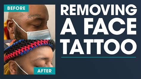 Face Tattoo Removal Before And After Motivation Monday Removery