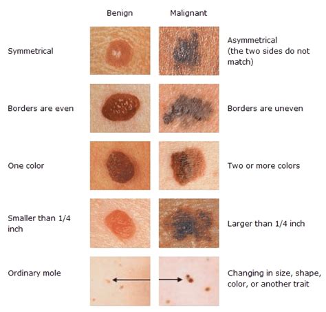 Skin Cancer Malignant Vs Benign Kaggle