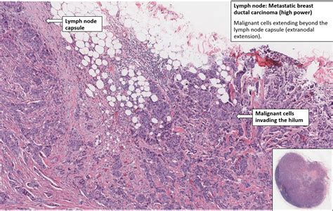 Metastatic Squamous Cell Carcinoma Lymph Node