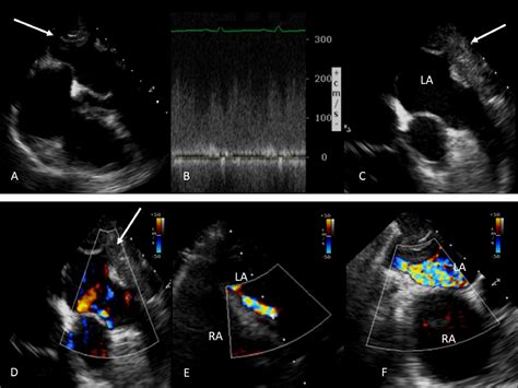 Pulmonary Artery Stenosis In A Patient With Prior Histoplasmosis And