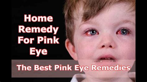 Home Remedy For Pink Eye The Best Pink Eye Remedies Youtube