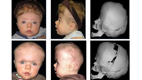 Craniosynostosis Surgery Childrens Hospital Of Philadelphia