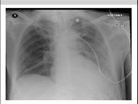 Figure 1 From Pneumothorax After Nasogastric Tube Insertion Semantic