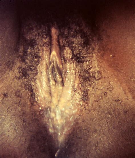 Herpes simplex virus, more commonly known as herpes affects 1 in 6 people. Herpes Simplex Virus | Johns Hopkins ABX Guide