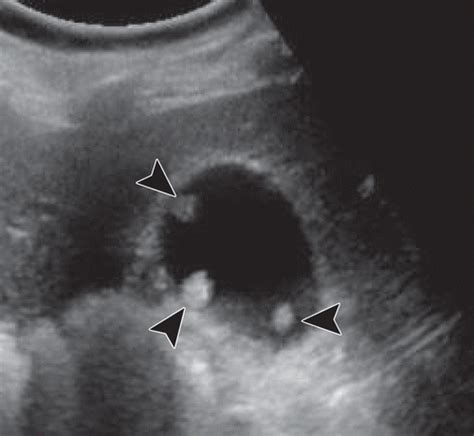 Polypoid Lesions Of The Gallbladder Disease Spectrum With Pathologic