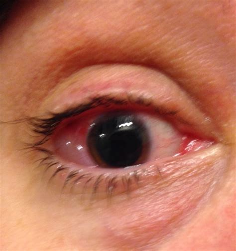 My Eye After Avastin Injection Eyes Ocular Medical