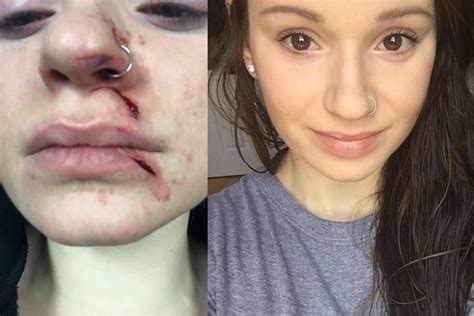 Nyc Slashing Victim Undergoes An Amazing Transformation 6
