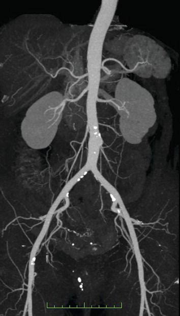 Angiography For Renal Artery Diseases Intechopen