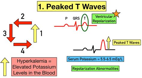 Hyperkalemia Ecg Changes Findings And Progression Of Effects On The