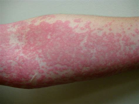 Allergy To Mold Symptoms Mold Allergy Rash Test And Treatment