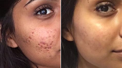 Controversial Cystic Acne Routine Goes Viral — Before And