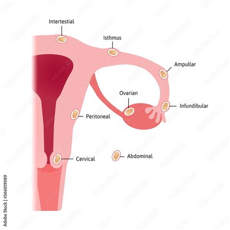 Fototapeta Ectopic Pregnancy Occurs In A Fallopian Tube Different