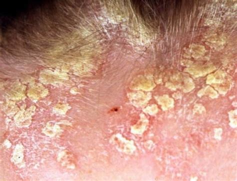 Seborrheic Dermatitis Images Symptoms And Pictures