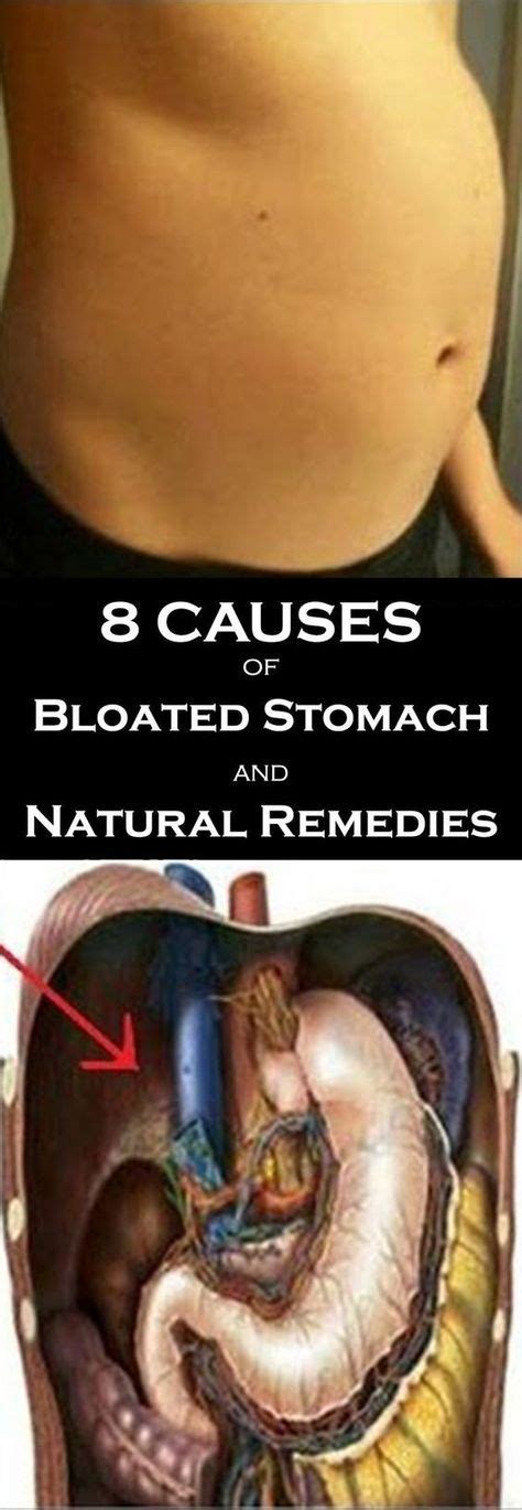 8 Causes Of Bloated Stomach And Natural Remedies Stomach Remedies Bloating Remedies Bloated