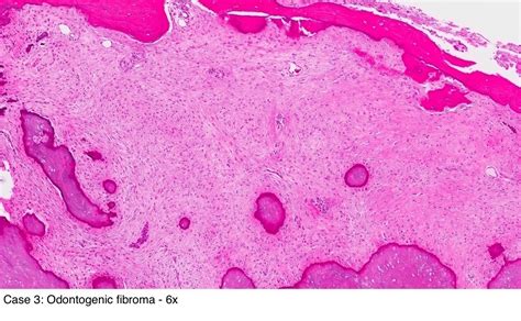 Pathology Outlines Odontogenic Fibroma