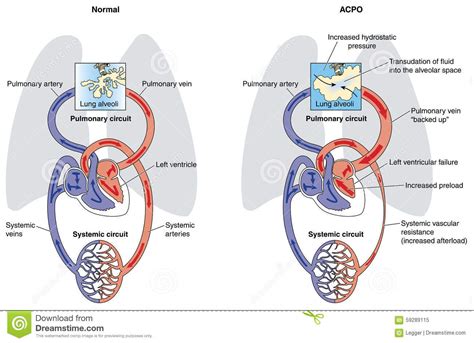 Acute Cardiogenic Pulmonary Oedema Stock Vector Illustration Of Acute