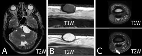 Overview Of Epidermoid Cyst European Journal Of Radiology Open