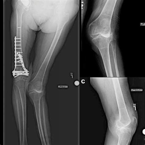 Preoperative Bone Length Study Of The Bilateral Lower Extremities A