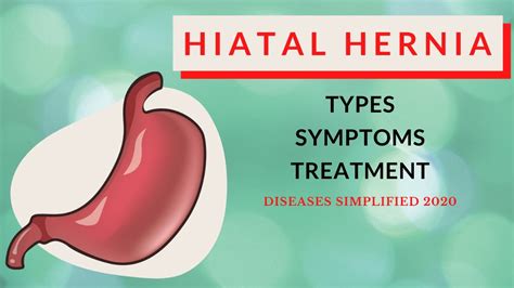 Hiatal Hernia Types Symptoms And Treatment Youtube