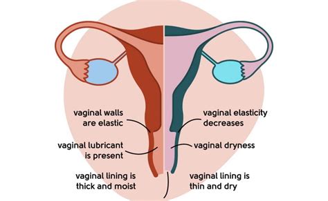 Vaginal Dryness Causes Symptoms Treatment