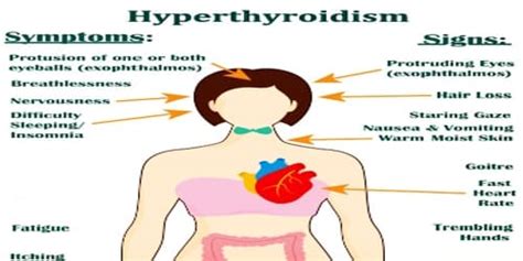Hyperthyroidism Symptoms Diagnosis And Treatment Msrblog