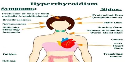 Hyperthyroidism Symptoms Diagnosis And Treatment Assignment Point