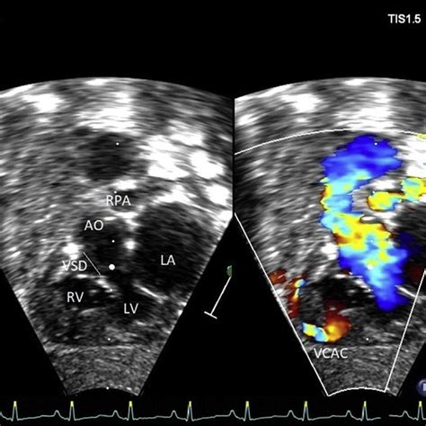 Echocardiographic Subcostal Short Axis View In Doppler Color Mode