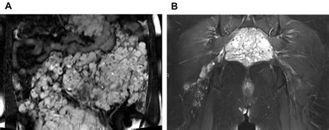 Imaging Of Vascular Malformations Radiology Key