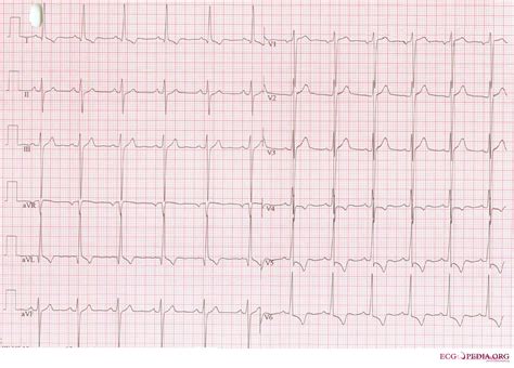 Left Ventricular Hypertrophy Electrocardiogram Wikidoc