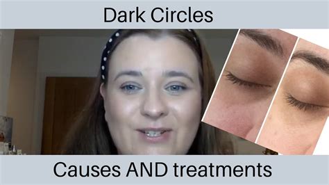 Dark Circles Under Eyes Top 3 Causes And Treatments Including