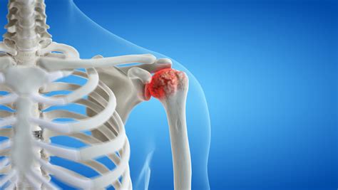 Shoulder Arthritis Signs Symptoms And Surgery Colorado Sports Doctor