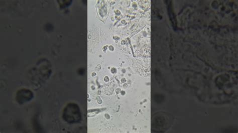 Trichomonas Vaginalis In The Urine Sediment Of A Patient Youtube