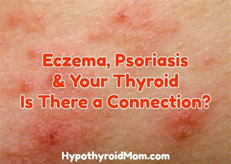 Eczema Psoriasis And Your Thyroid Is There A Connection Hypothyroid Mom