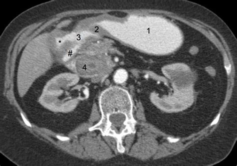 Abdominal Computed Tomography Ct Scan With Intravenous And Oral