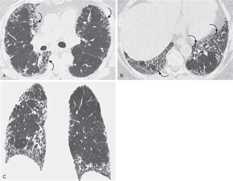 Usual Interstitial Pneumoniaidiopathic Pulmonary Fibrosis Radiology Key