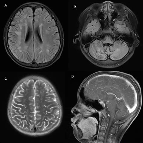 The Brain Mri Showed Abnormal Signals In The Case Of Fhl 2 White