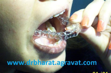 What Are Clear Braces Or Invisible Braces Famous Best Cosmetic