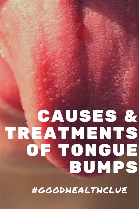 Dec 20, 2017 · to use honey as a natural remedy for lie bumps, this is what you should do: Causes and Treatments of Tongue Bumps | Good Health Clue ...