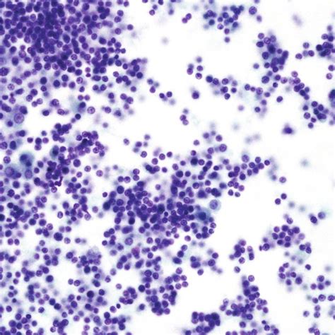 Cytology Of Ascitic Fluid A The Smear Is Moderately Cellular With