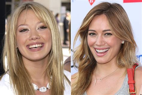 Celebrities Gone Dental Before And After Photos Of Toothy