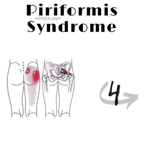 Dr Katie Clare On Instagram “four Glute Moves For Piriformis Syndrome💫 So Why Does