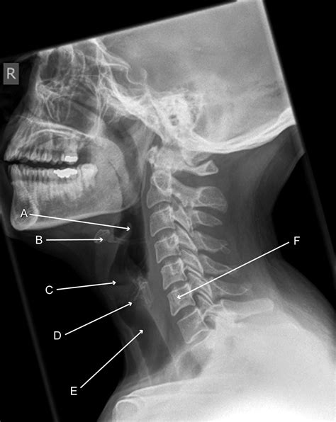 Radiograph Showing The Soft Tissues Of The Neck Lateral View The Bmj