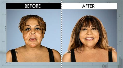 Botched Plastic Surgery Cement Before And After