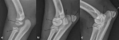 Lateral Elbow Radiographs Illustrating The Development Of The Medial