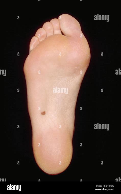 Pigmented Lesion On Sole Of Foot Stock Photo Alamy
