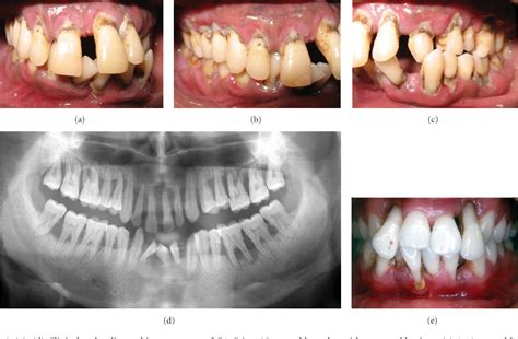 Figure From Generalized Aggressive Periodontitis And Its Treatment