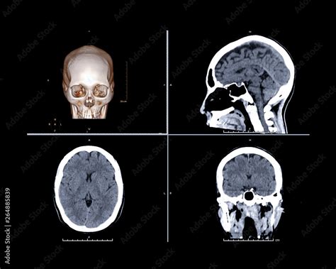 Ct Brain Trauma Comparison 3d Rendering Image Sagittal Axial And